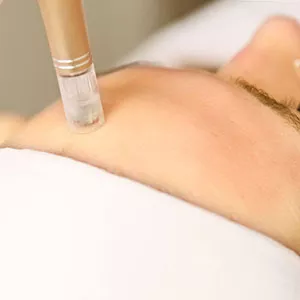 Dermapen Microneedling
